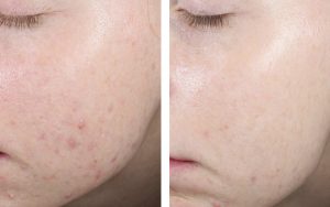 Zlepšení akné a textury kůže
