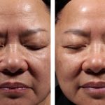 Zlepšení vrásek na čele a celkové jasnosti pleti po chemickém peelingu