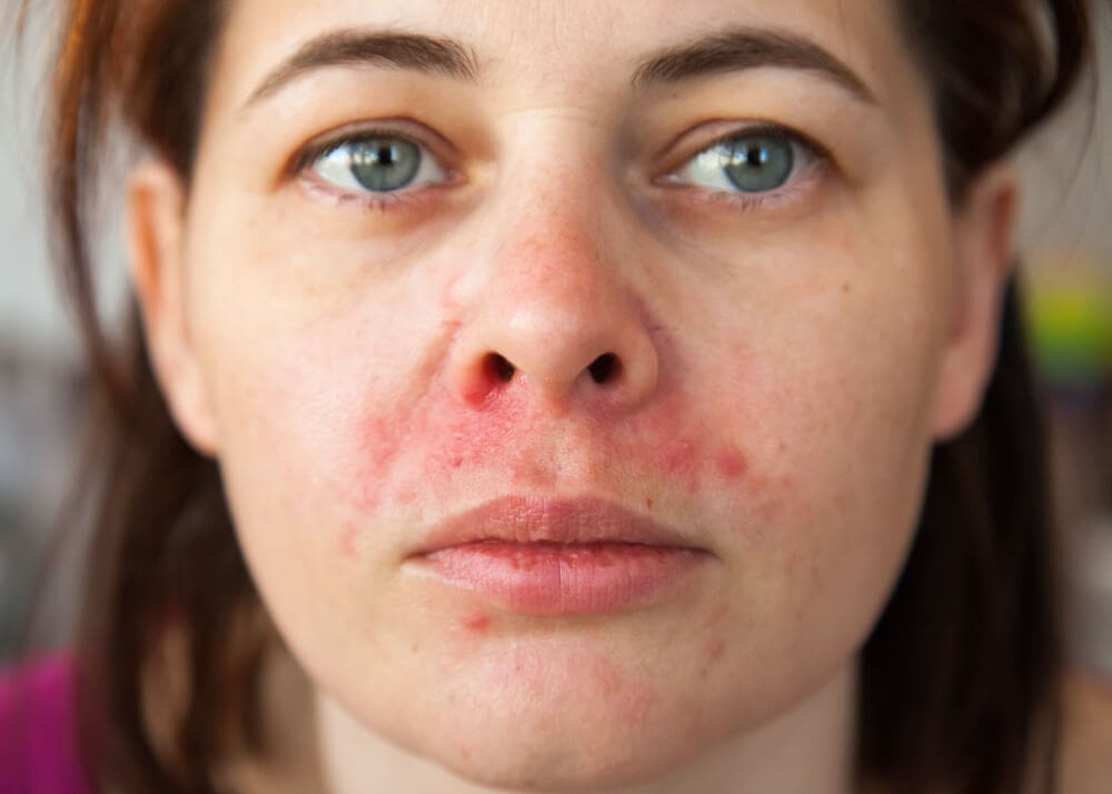 Periorální dermatitida se objevuje hlavně kolem úst