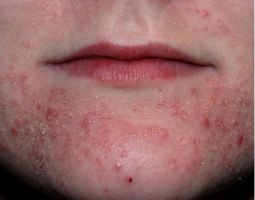 Periorální dermatitida se projevuje hlavně na bradě a kolem úst