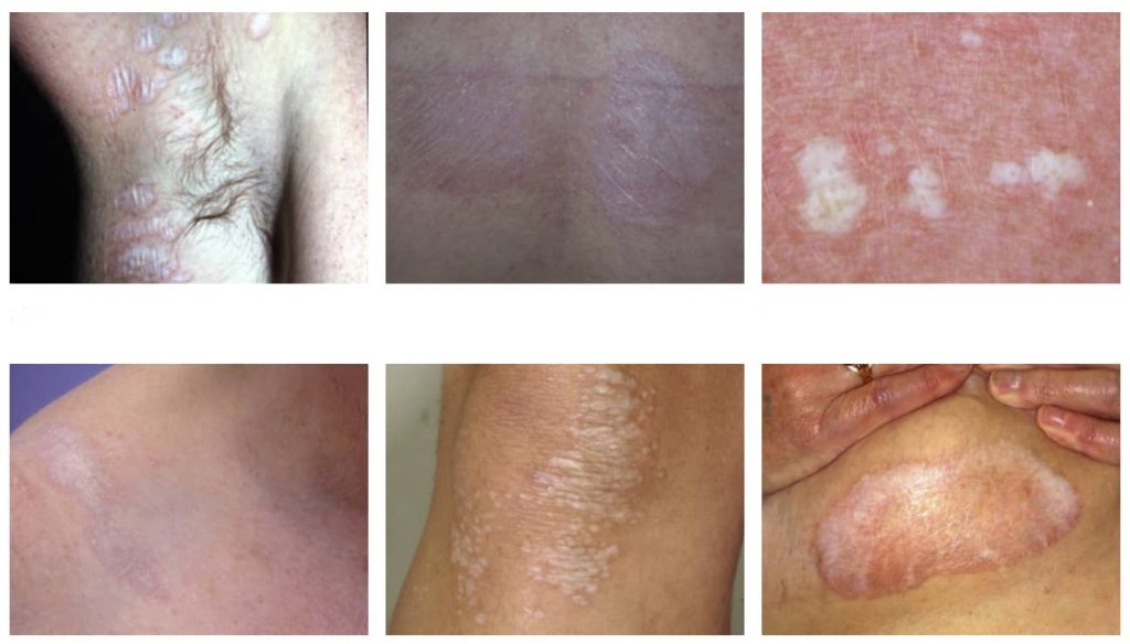 Poškozená kůže může časem ztrácet svoji elasticitu