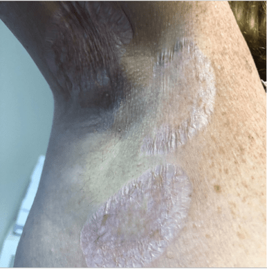 Extragenitální poškození kůže je u lichen sclerosus vzácné, ale možné
