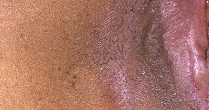 Lichen sclerosus se objevuje hlavně na kůži v okolí genitálu a konečníku