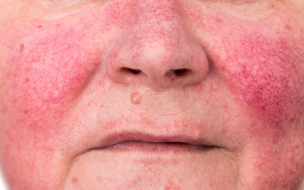 Rosacea se projevuje erytémem v prostřední části obličeje
