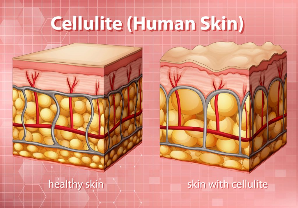 Příčinou celulitidy je působení tlaku z tuku v podkoží na pokožku