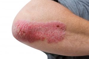 Lupénka – proč vzniká a jak léčit její projevy?