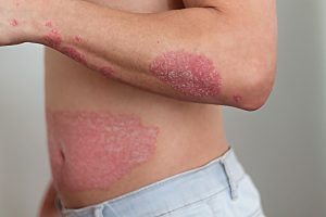 Biologická léčba atopického ekzému a psoriázy