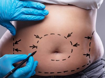 Laserová liposukce břicha
