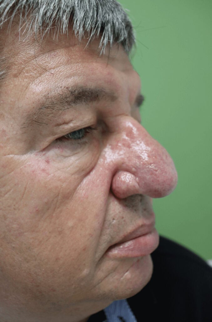 Zarudnutí je běžné