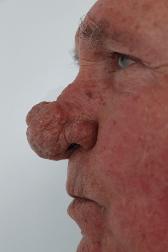 Nos bývá zvětšen